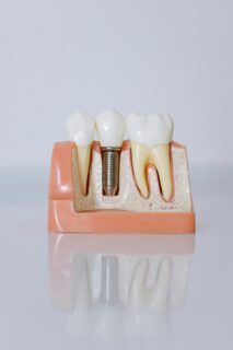 Dental Implant
