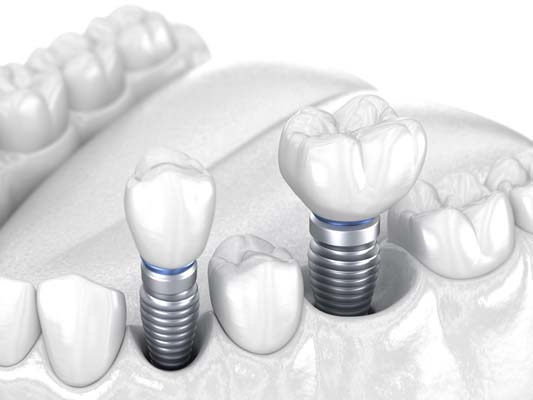 Reasons That Implant Dentures Are A Convenient Solution To Tooth Loss